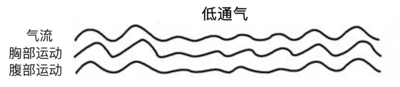 低通气.png