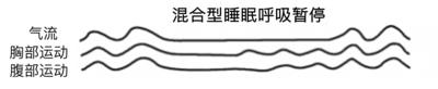 混合型.png
