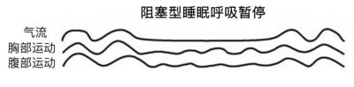 阻塞型.png